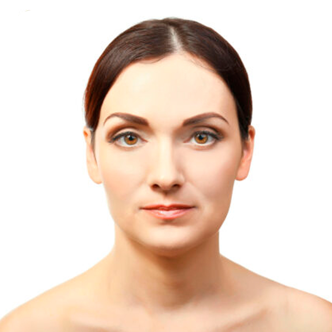 Después del tratamiento: Blefaroplastia No Invasiva