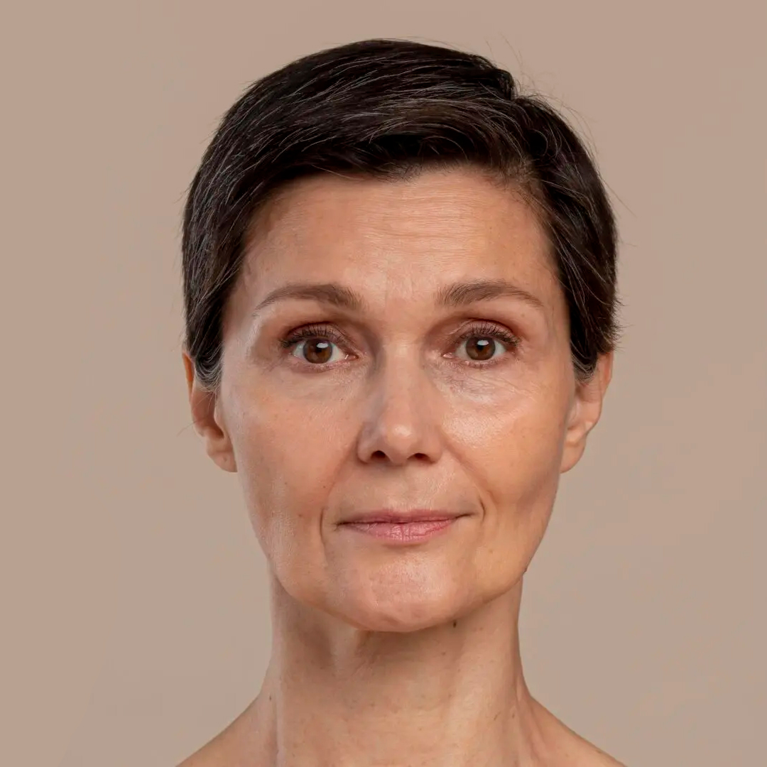 Antes del tratamiento: Lifting Facial (Fibroblast)