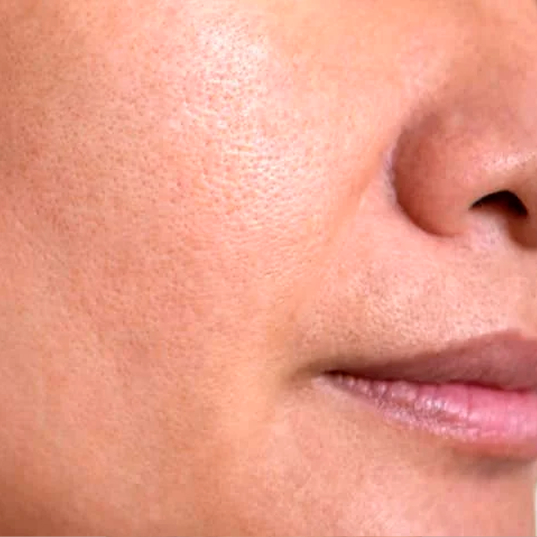 Después del tratamiento: Remoción de Léntigos Solares