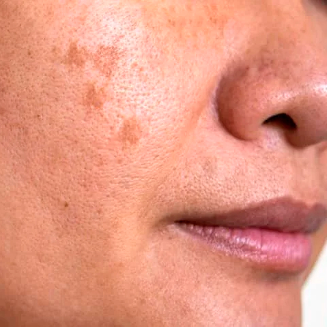 Antes del tratamiento: Remoción de Léntigos Solares