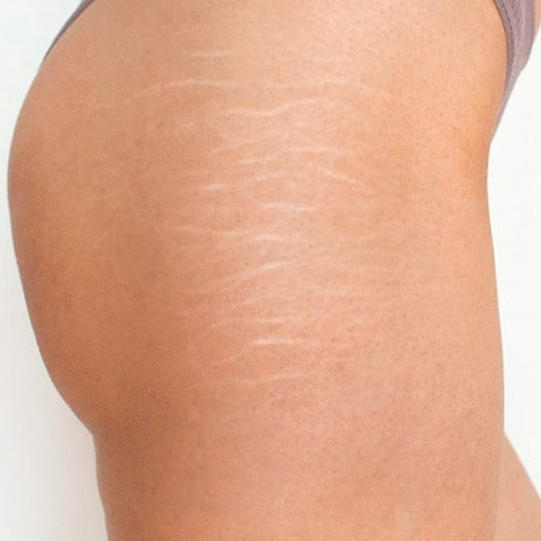 Antes del tratamiento: Tratamiento de Estrías